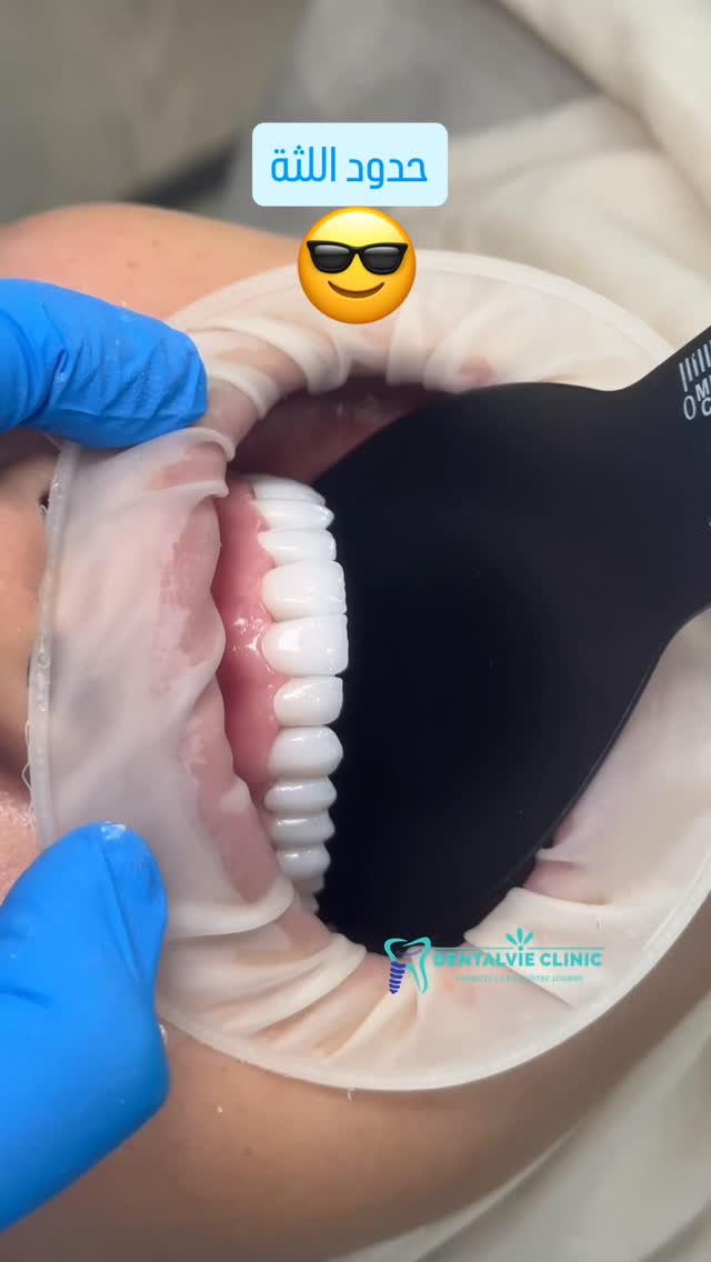 Sculpture du Contour Gingival
