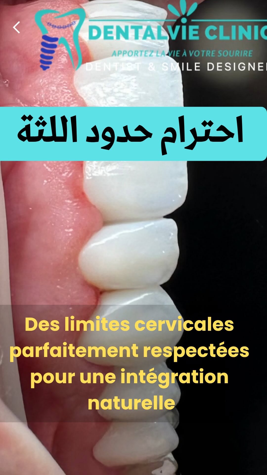 Rénovation & Zircone Haute Précision